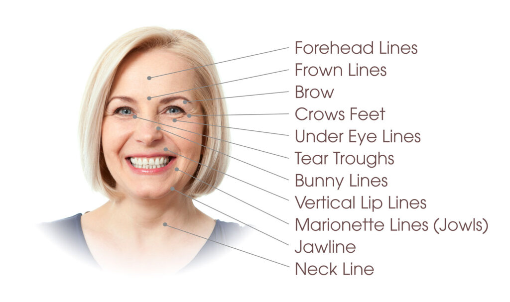 Botox® Cosmetic Treatment Areas