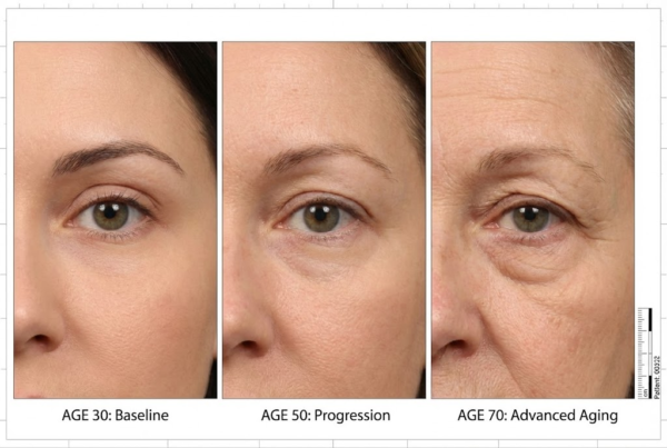 Eyelid aging progression over time showing upper lid hooding and lower lid bags in Bakersfield patients